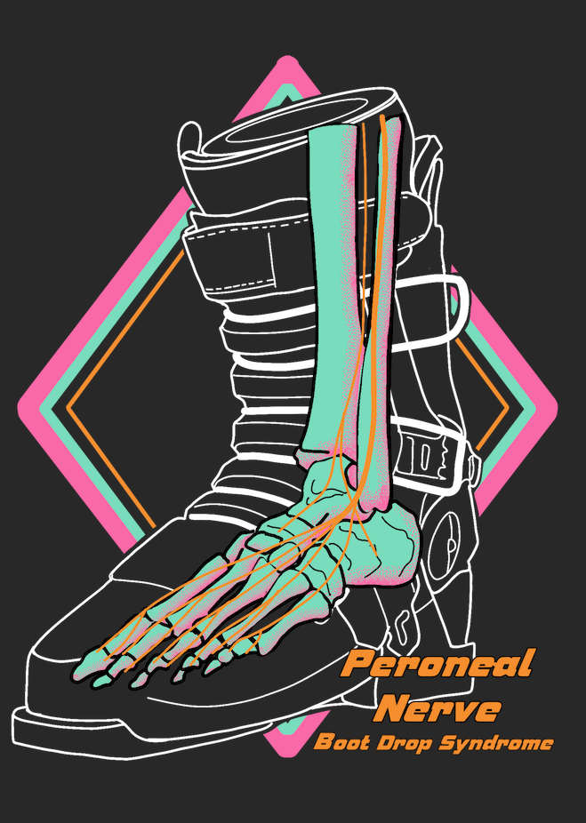 Boot Drop Boot Drop Syndrome – The Savage Anatomist